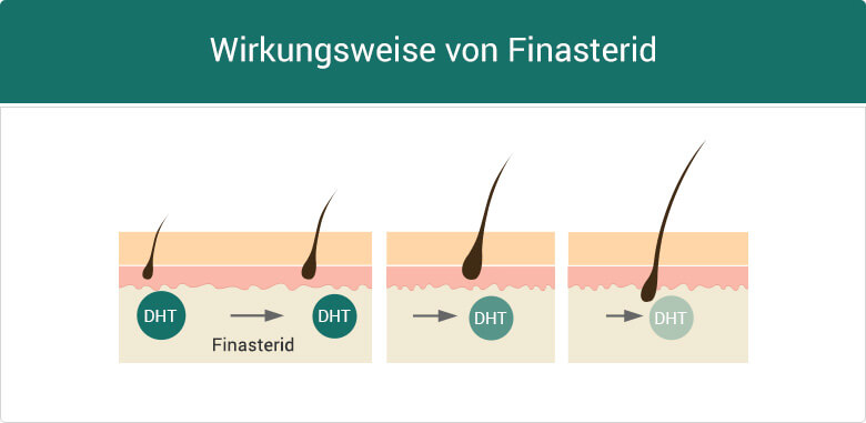 Wirksamkeit von Finasterid